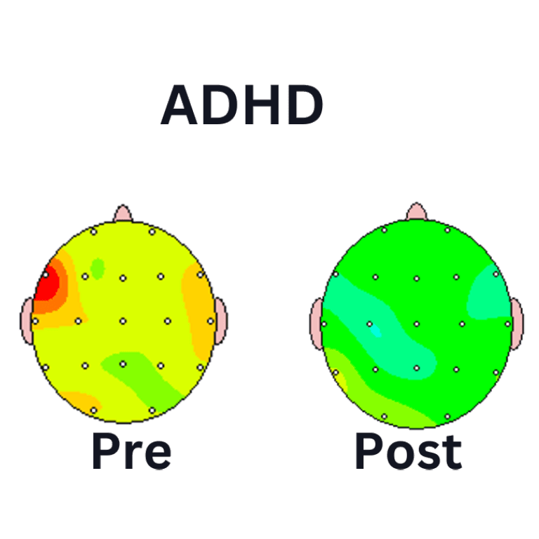 ADHD Pre Cost