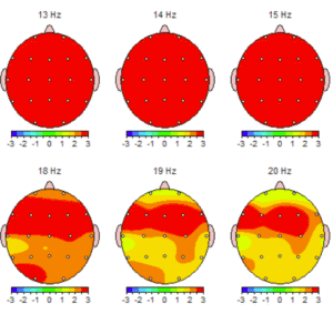 brain scan for dementia reversal florida