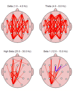 qeeg Brain Mapping Tampa Fl