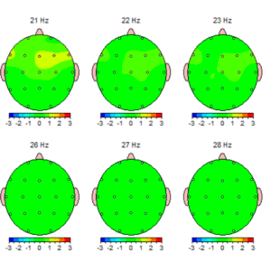 tms therapy alzheimers treatment tampa