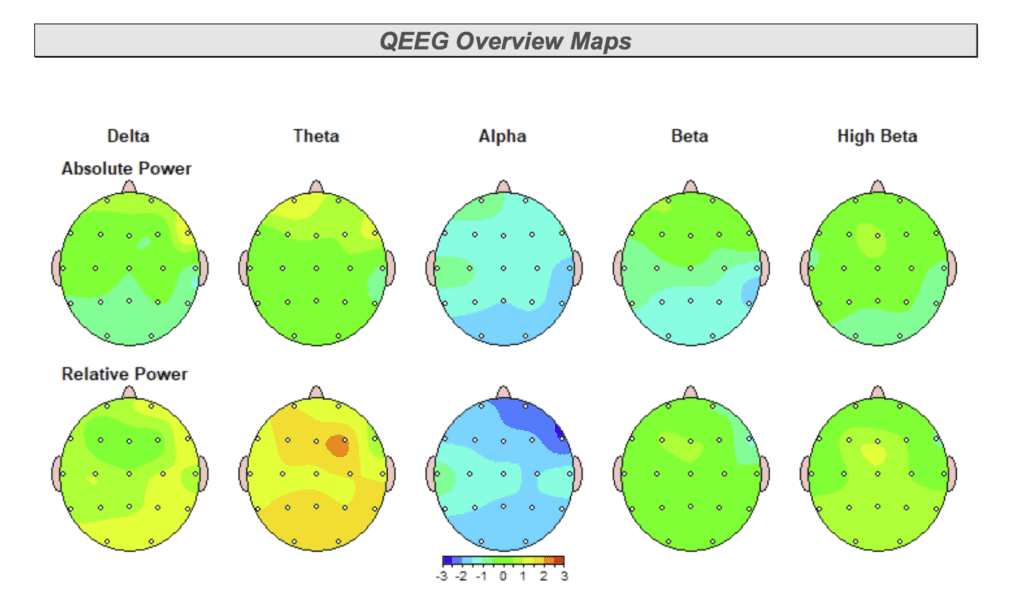 qEEG Brain Mapping Car Accident