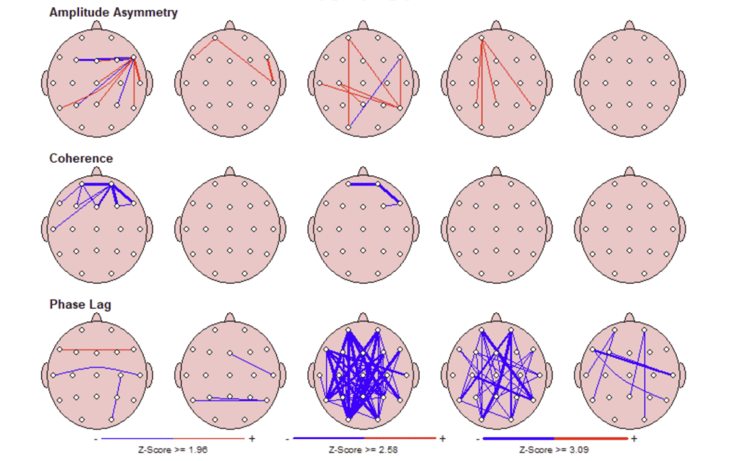 qEEG Brain Mapping of a mTBI
