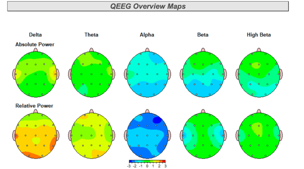 qeeg brain mapping of a tbi tampa