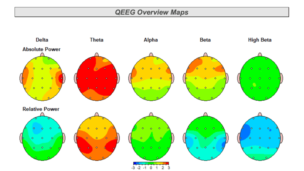 qEEG Overview Maps