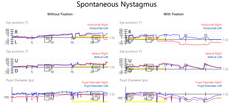 Eye Movement Test