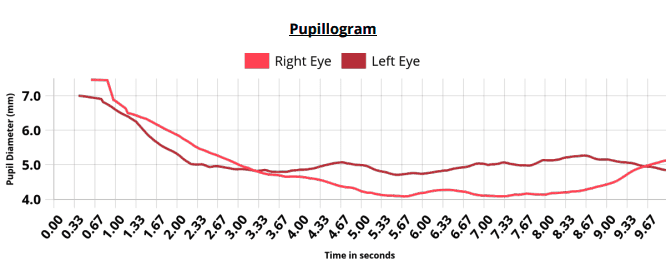 Pupillometry test