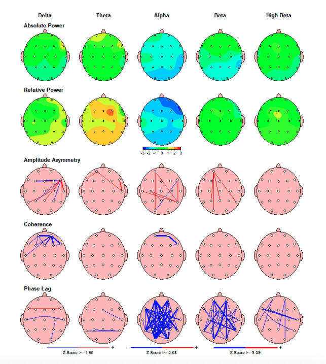 qEEG Concussion