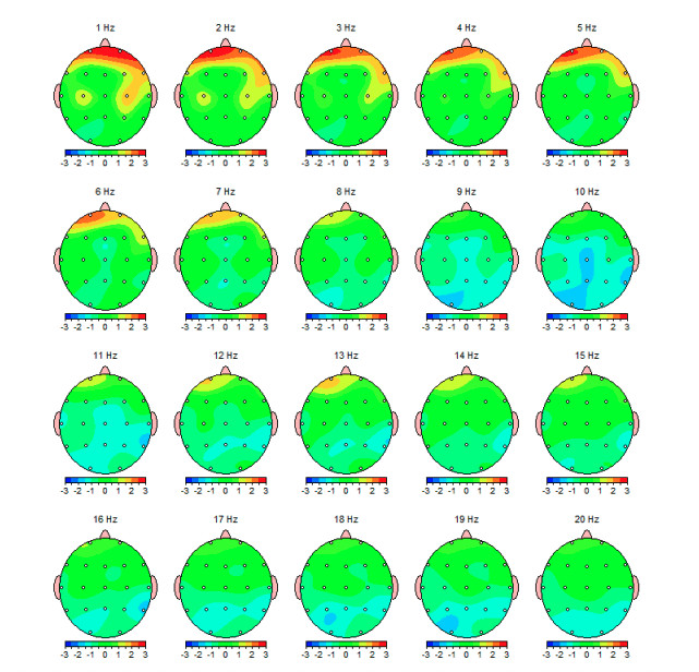 qEEG Test Concussion