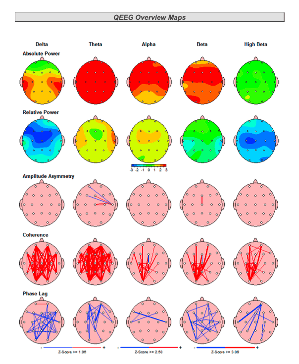 brain fog qEEG Brain map